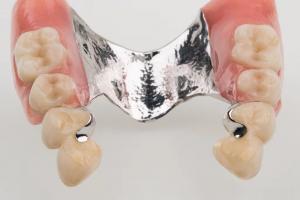 China Dental Precision Attachment Partial Denture Ivoclar Scheftner on sale