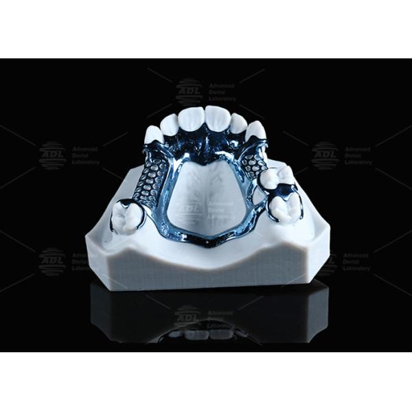 Hypoallergenic Adjustable And Customizable 3D Printed Titanium Framework With