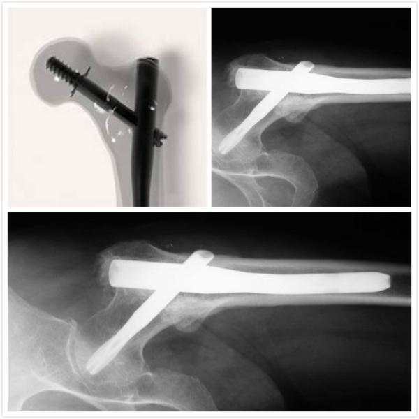 PFNA Intramedullary Nail Fixation , Orthopedic Implants Proximal Femoral Nail
