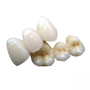 China Porcelain Bridge Crown Tooth Strong Stability None Foreign Body Sensation on sale