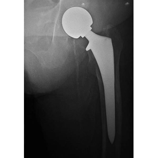 D1C100 Total Hip Replacement , HNS / UHMWPE Material Bipolar Femoral Head