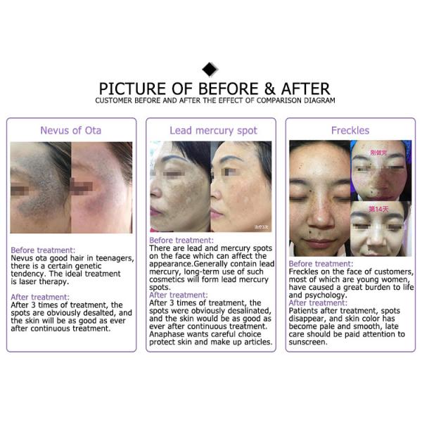 Picopulse best CE approved Picosecond 532NM ND-YAG tattoo removal korean price pico laser machine