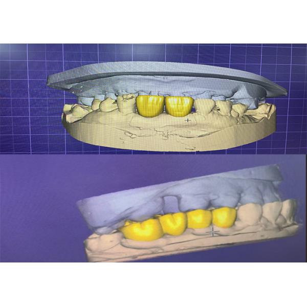 Premium Zirconia Dental Crowns for Superior Strength and Natural Aesthetics