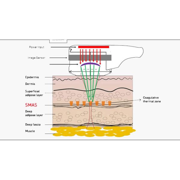 Hifu high intensity focused ultrasound for face lifting with vertical stand