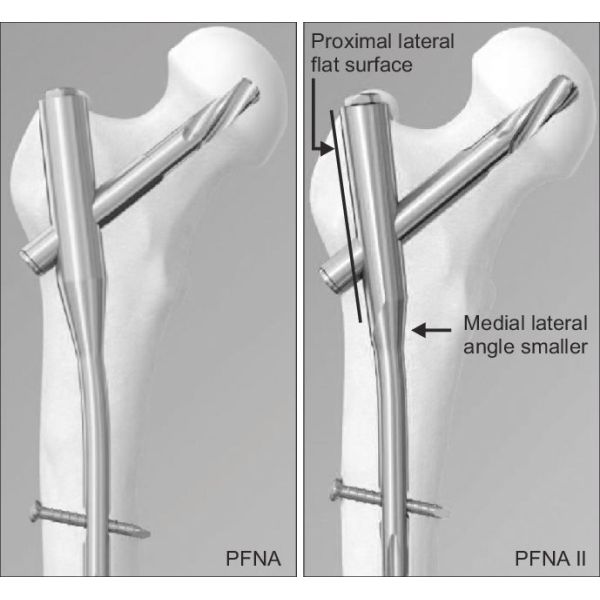 PFNA Intramedullary Nail Fixation , Orthopedic Implants Proximal Femoral Nail