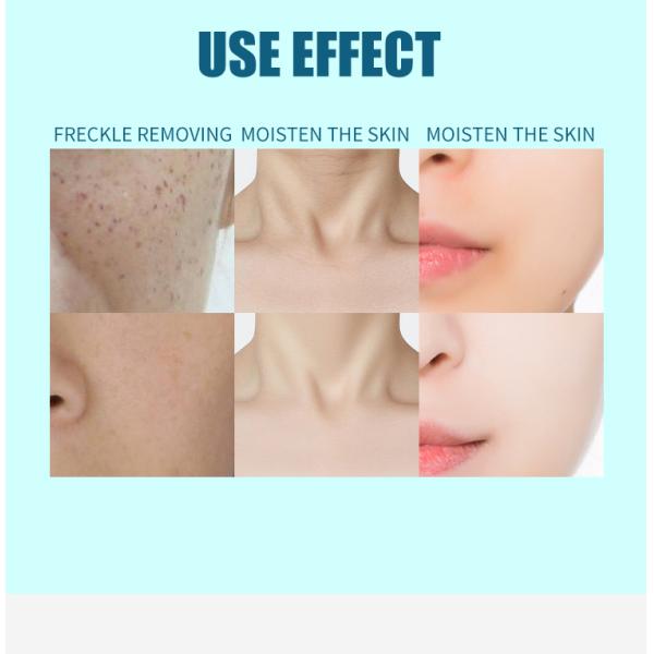 Commercial Q Switched ND YAG Laser Machine 1064 532 1320nm Nd Yag Tattoo Removal Machine