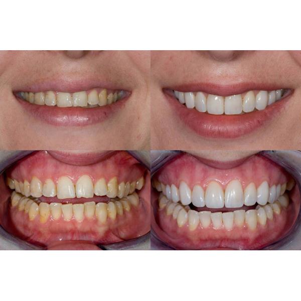 10mm Ceramic Translucent Zirconia Blocks 10 PCS IPS Emax Ingots