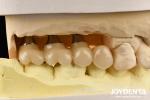 Ultra-precision processing Zirconia Implants All-Zirconium Integrated Crown