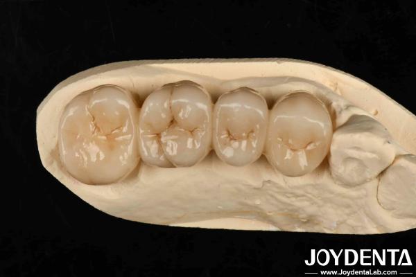 Cheap Multilayer Full Zirconia White Style With Layers High Translucency High Resistance To Cracking for sale