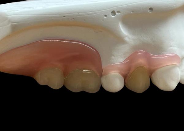 Cheap Adjustable Invisible Flexible Denture: Secure Fit for Comfortable Chewing and Speaking with Varying Durability for sale