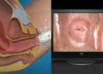 Digital Endoscope Self-Inspect Colposcope Mini Colposcopy with Range of