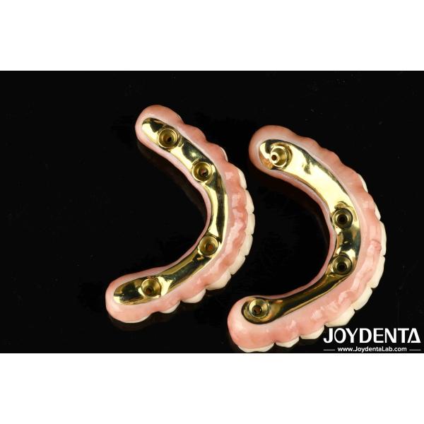 Natural-looking Aesthetics Zirconia Hybrid Bridge With High Durability And