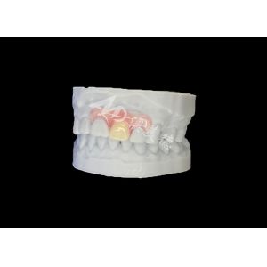 Customized Nesbit Flexible Partial Denture for Natural Fit and Longlasting