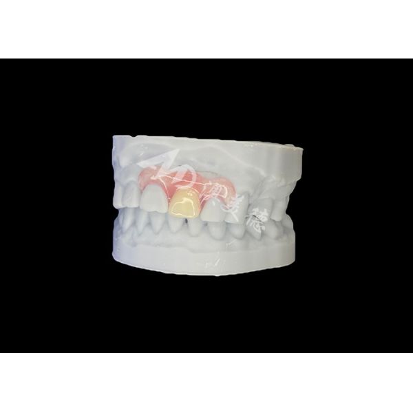 Customized Nesbit Flexible Partial Denture for Natural Fit and Longlasting