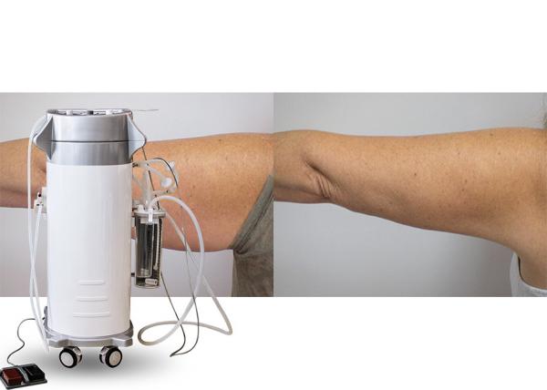 Cheap Power Assisted Surgical Vacuum Liposuction Cavitation Machine For Thighs / Arms / Back Treatment for sale