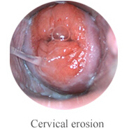 Mini Colposcope for Cervical Examintion Self - Exam Digital Electronic Colposcope BS1 Connected to TV