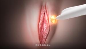 Quality Female RF Vaginal Rejuvenation Thermage Vulva Rejuvenation Laser Urinary Incontinence wholesale